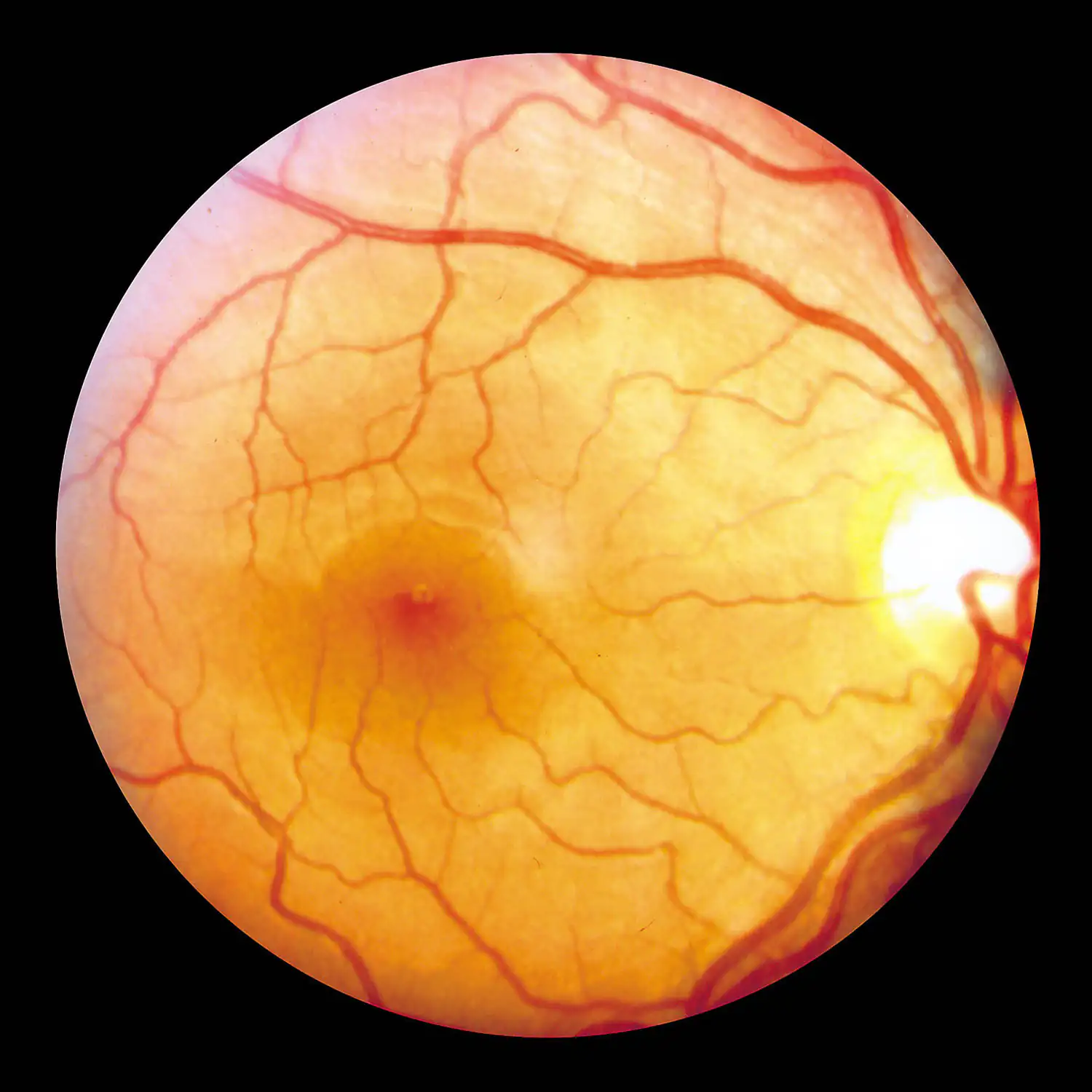 Retina del ojo Primer plano de la retina humana, colores naranjas, vista superior, muestra capilares y estructura.